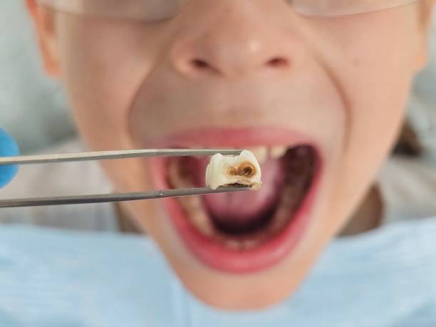 Best Emergency Broken Tooth Repair in South Sioux City, NE
